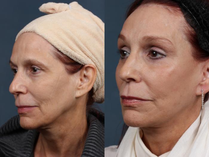 Before & After Facelift Case 509 View #4 View in Louisville & Lexington, KY