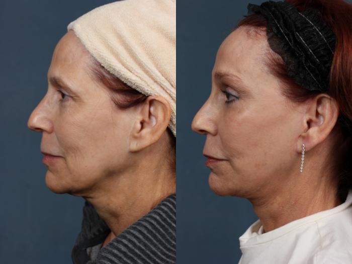 Before & After Facelift Case 509 View #5 View in Louisville & Lexington, KY