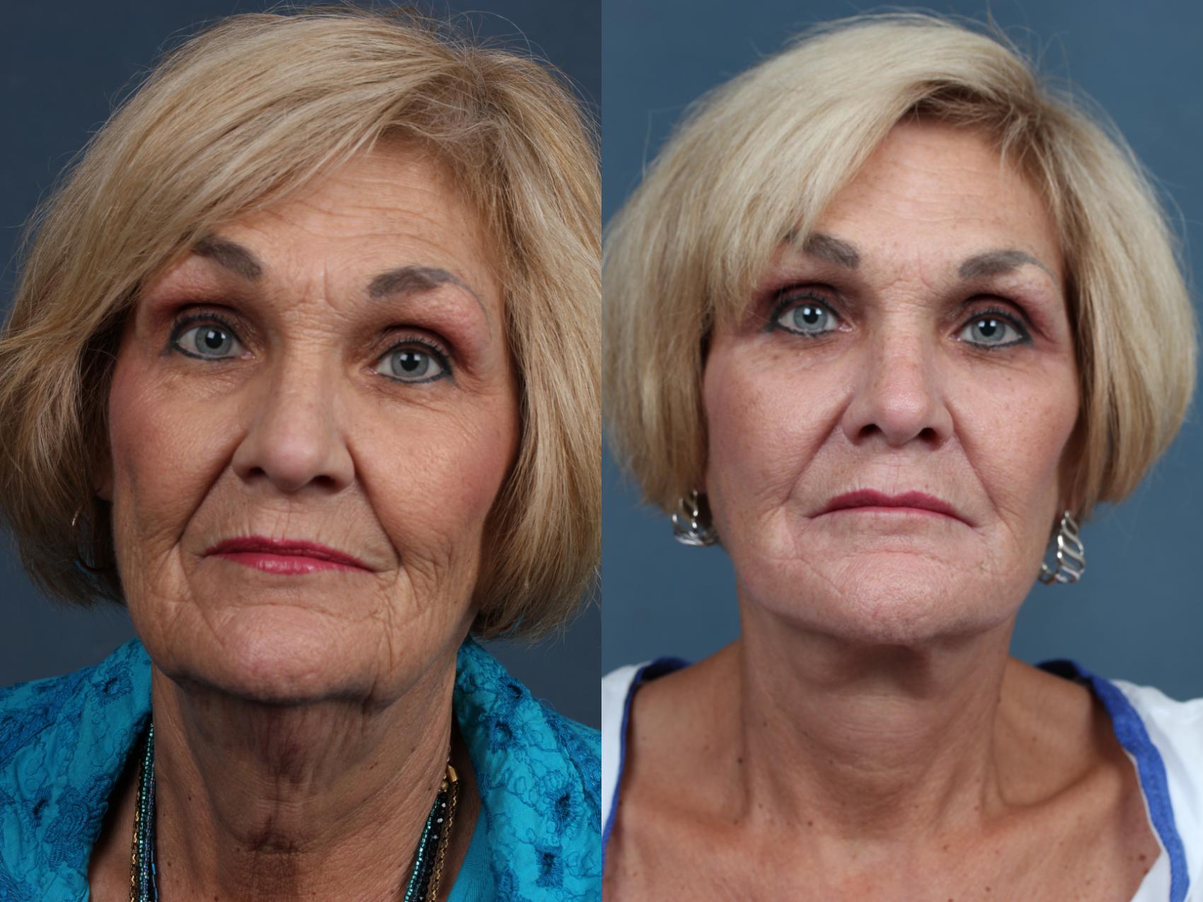 Facelift Case 510 Before & After View #1 | Louisville, KY | CaloSpa® Rejuvenation Center