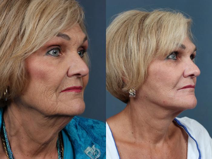 Facelift Case 510 Before & After View #2 | Louisville, KY | CaloSpa® Rejuvenation Center
