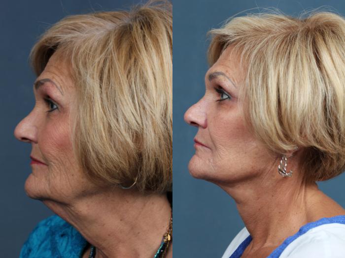 Facelift Case 510 Before & After View #3 | Louisville, KY | CaloSpa® Rejuvenation Center