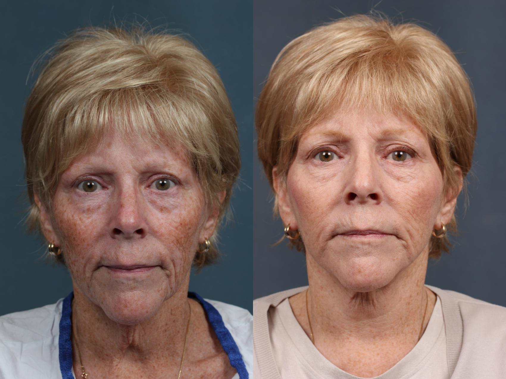 Before & After Facelift Case 511 View #1 View in Louisville & Lexington, KY
