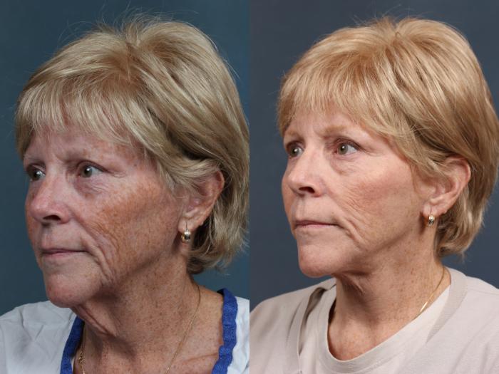 Before & After Facelift Case 511 View #2 View in Louisville & Lexington, KY