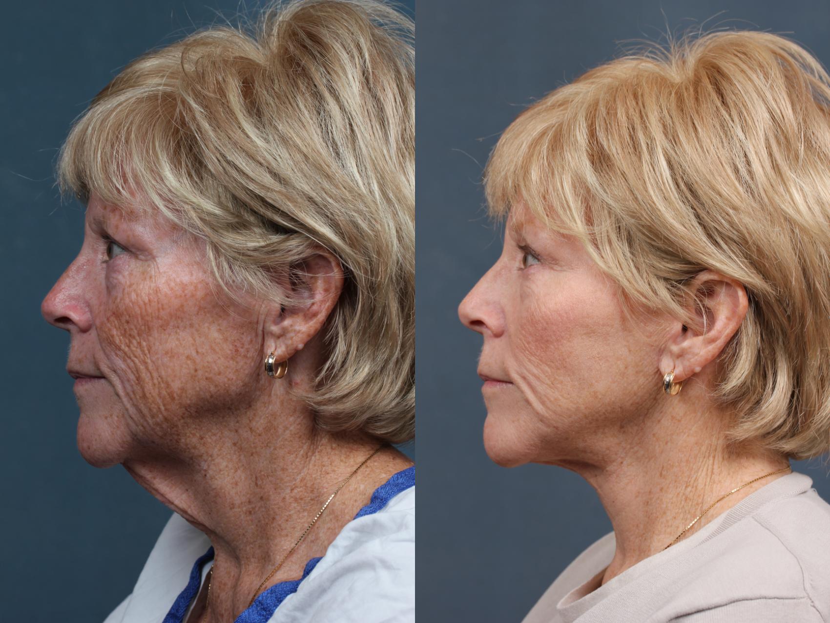 Before & After Facelift Case 511 View #3 View in Louisville & Lexington, KY