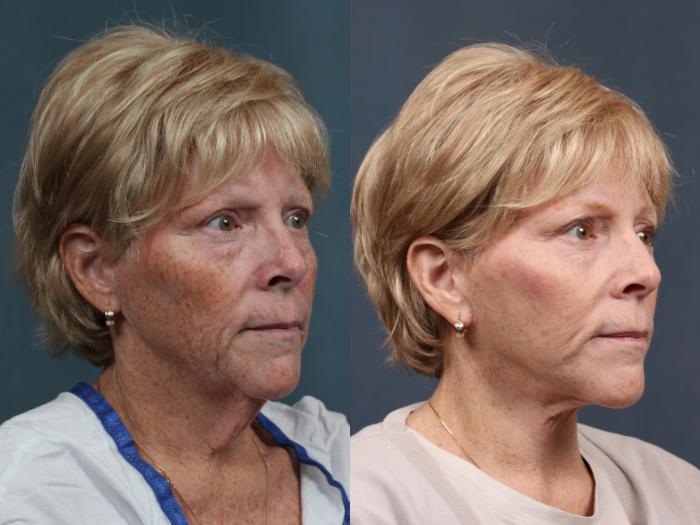 Facelift Case 511 Before & After View #4 | Louisville, KY | CaloSpa® Rejuvenation Center