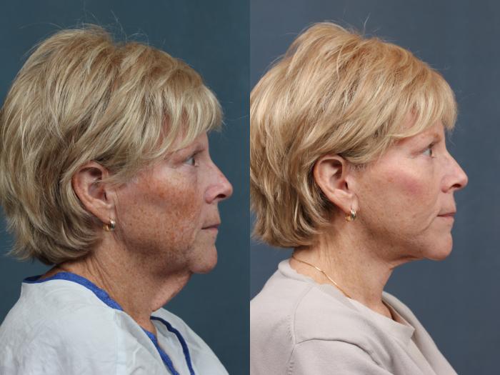 Before & After Facelift Case 511 View #5 View in Louisville & Lexington, KY