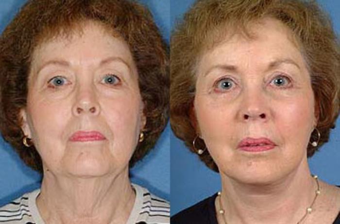 Before & After Facelift Case 61 View #1 View in Louisville & Lexington, KY