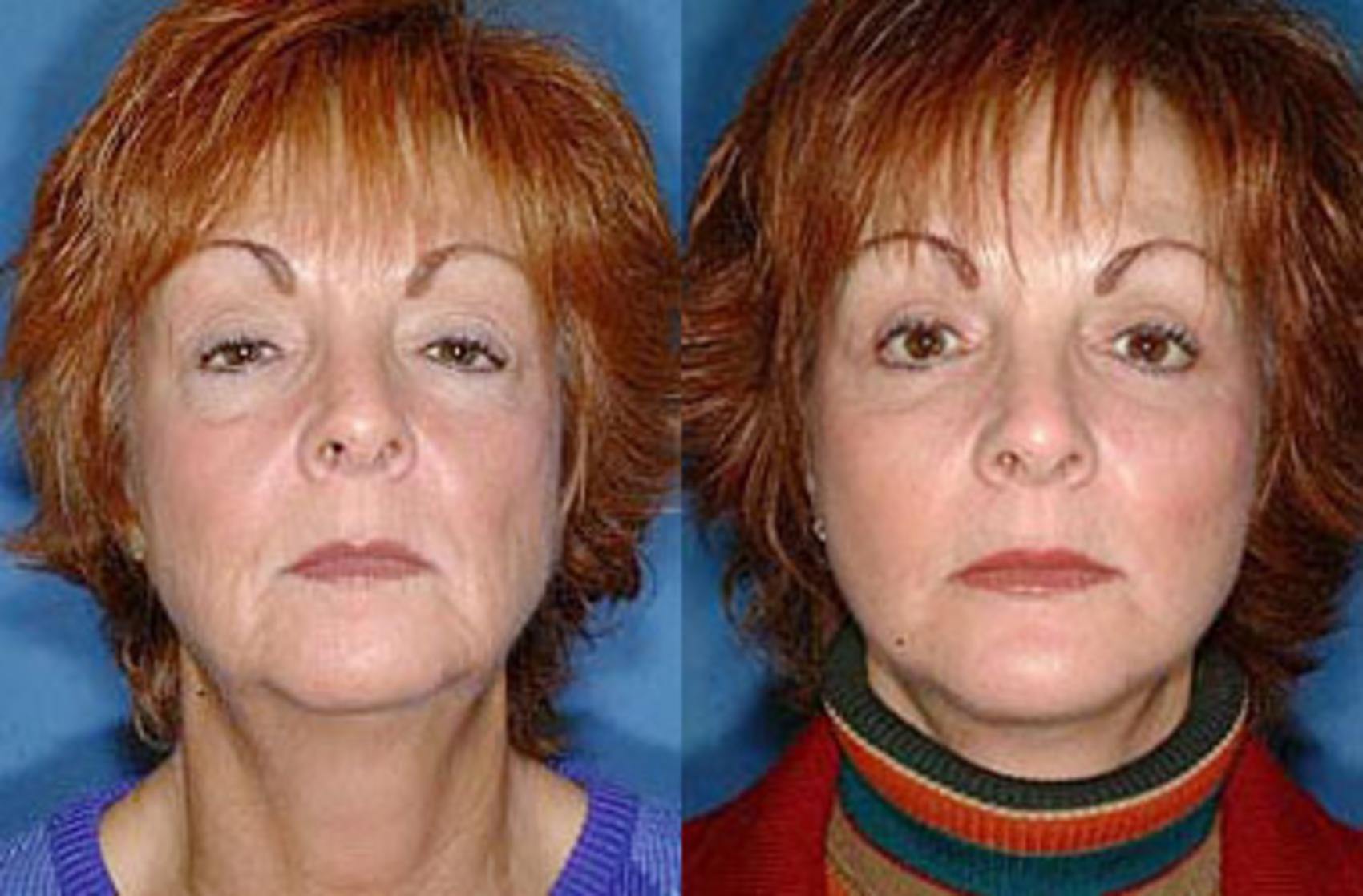 Before & After Facelift Case 62 View #1 View in Louisville & Lexington, KY