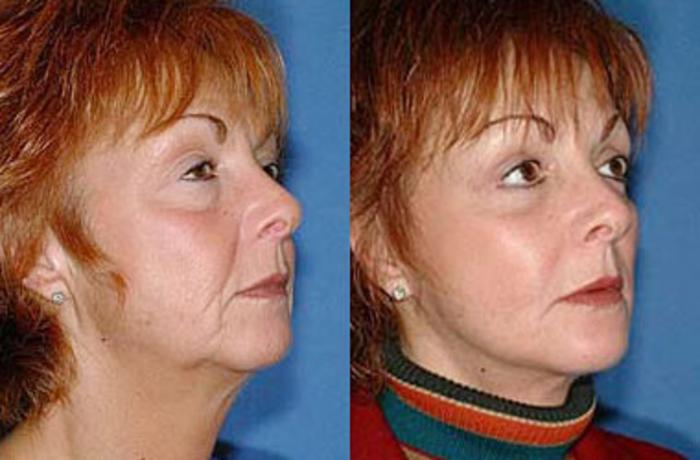 Before & After Facelift Case 62 View #2 View in Louisville & Lexington, KY
