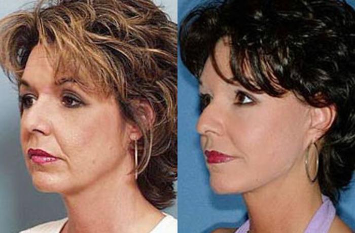 Before & After Facelift Case 63 View #2 View in Louisville & Lexington, KY