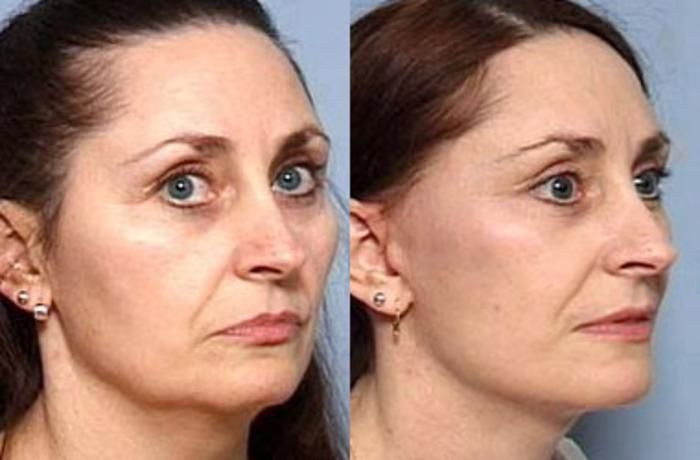 Before & After Facelift Case 64 View #2 View in Louisville & Lexington, KY