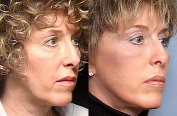 Facelift Case 67 Before & After View #2 | Louisville, KY | CaloSpa® Rejuvenation Center