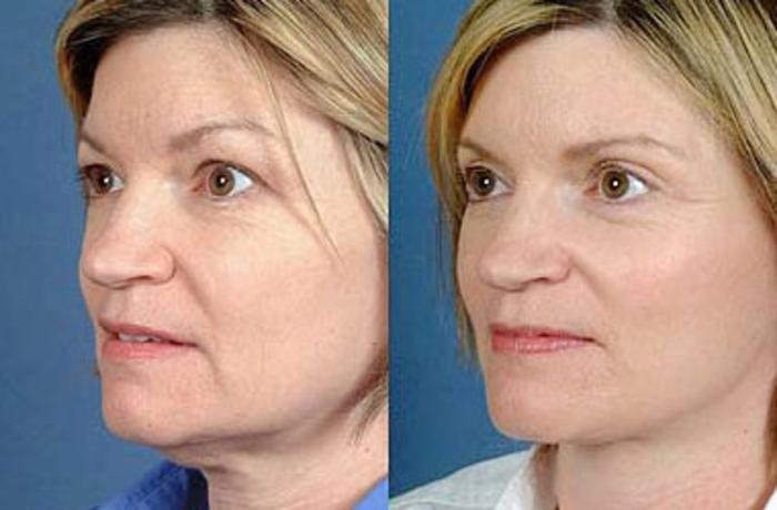 Before & After Facelift Case 68 View #2 View in Louisville & Lexington, KY