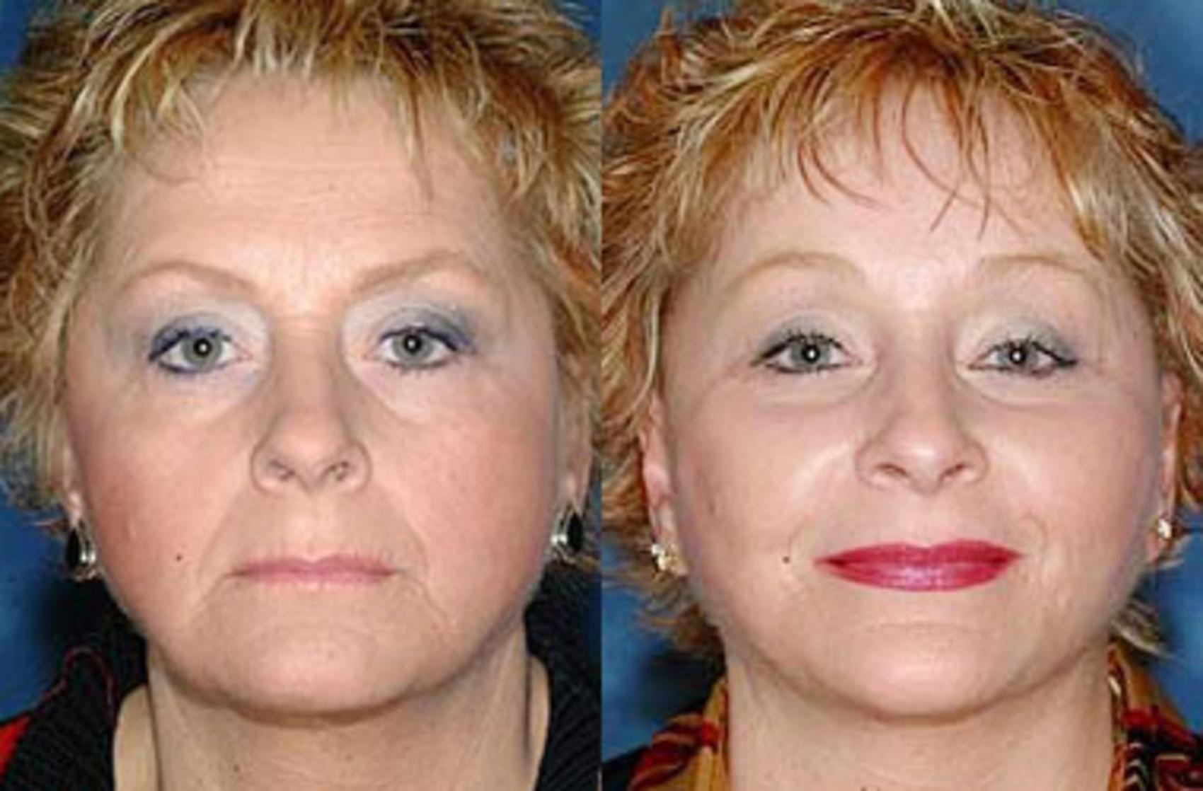 Before & After Facelift Case 71 View #1 View in Louisville & Lexington, KY