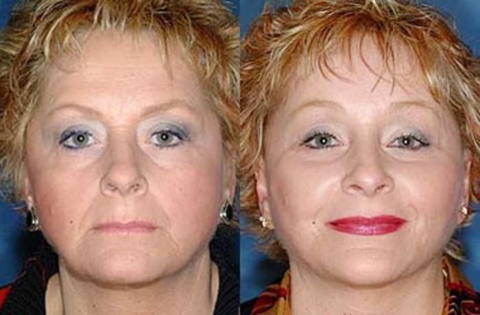 Facelift Case 71 Before & After View #1 | Louisville, KY | CaloSpa® Rejuvenation Center