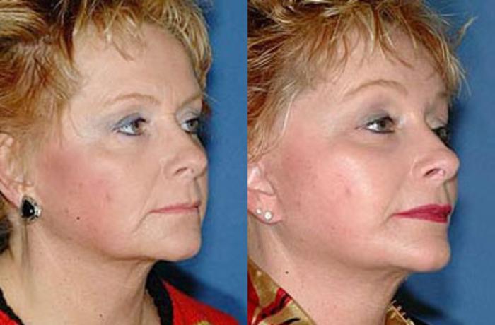 Facelift Case 71 Before & After View #2 | Louisville, KY | CaloSpa® Rejuvenation Center