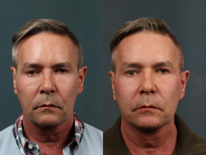 Before & After Eyelid Surgery Case 714 Front View in Louisville & Lexington, KY