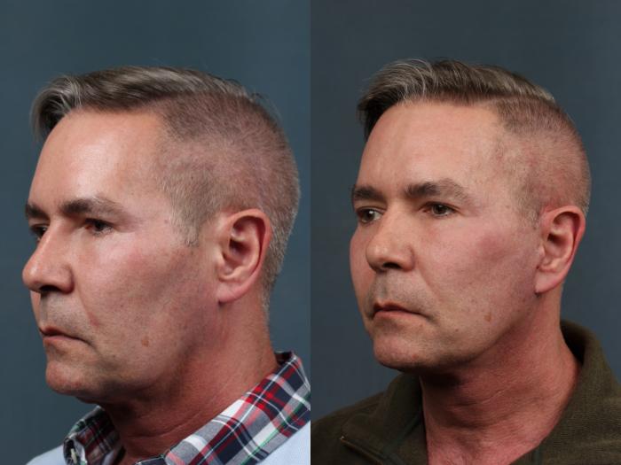Facelift Case 714 Before & After Right Oblique | Louisville, KY | CaloSpa® Rejuvenation Center