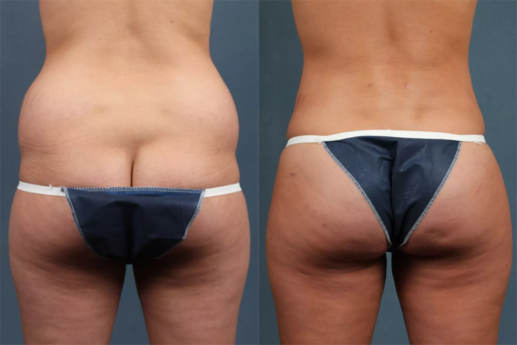 Breast and Buttock Augmentation Using Fat Grafting – The Full Overview