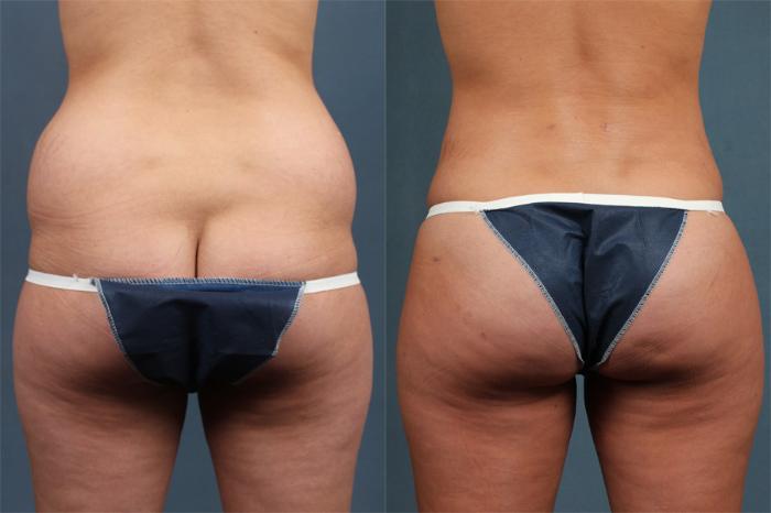 Before & After Brazilian Butt Lift Case 252 View #1 View in Louisville & Lexington, KY