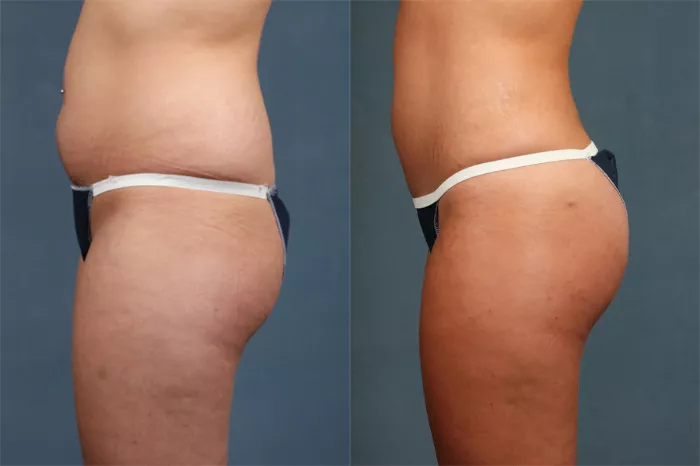 Fat Transfer and Tummy Tuck