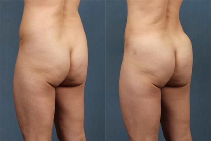 Brazilian Butt Lift Case 253 Before & After View #2 | Louisville, KY | CaloSpa® Rejuvenation Center