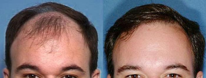 Before & After Hair Transplant Case 104 View #1 View in Louisville, KY