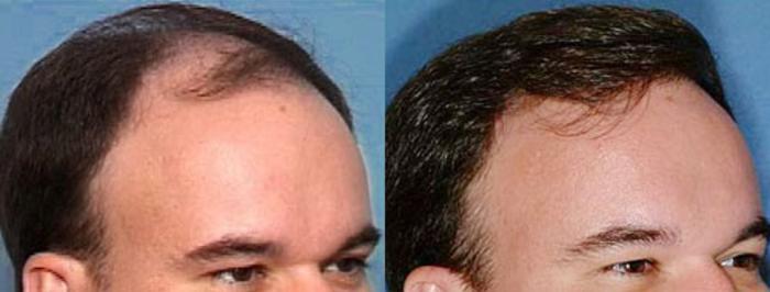 Hair Transplant Case 104 Before & After View #2 | Louisville, KY | CaloSpa® Rejuvenation Center