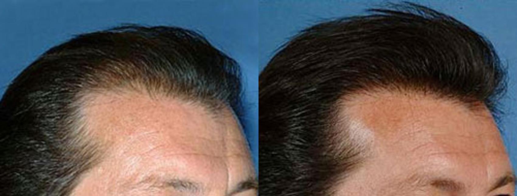 Hair Transplant Before & After Photos Patient 105 Louisville, KY