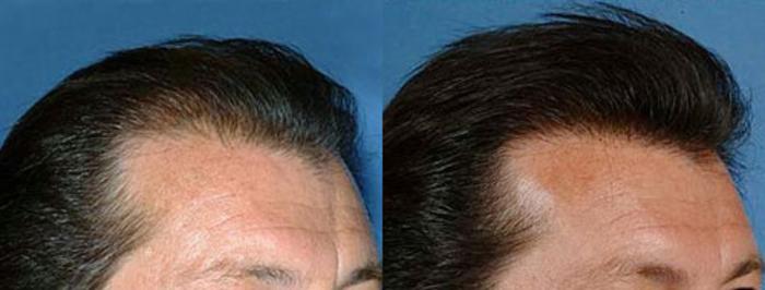 Hair Transplant Case 105 Before & After View #2 | Louisville, KY | CaloSpa® Rejuvenation Center