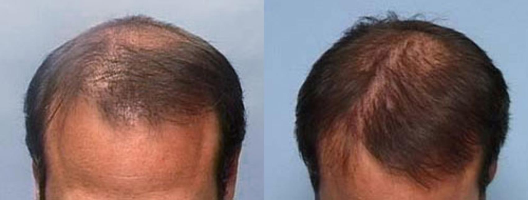 Before & After Hair Transplant Case 106 View #1 View in Louisville, KY