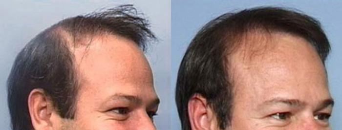 Hair Transplant Case 106 Before & After View #2 | Louisville, KY | CaloSpa® Rejuvenation Center