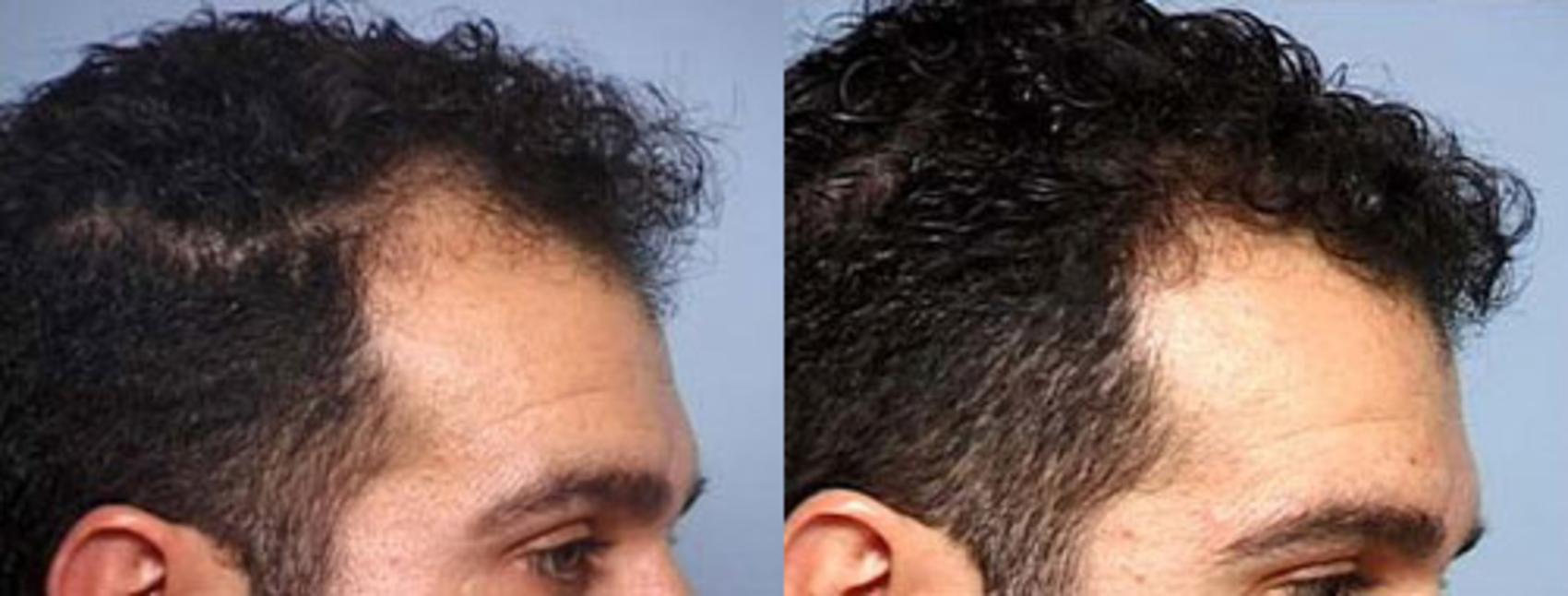 Before & After Hair Transplant Case 107 View #1 View in Louisville, KY