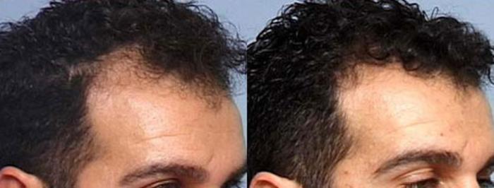 Hair Transplant Case 107 Before & After View #2 | Louisville, KY | CaloSpa® Rejuvenation Center