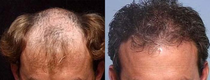 Before & After Hair Transplant Case 108 View #1 View in Louisville & Lexington, KY