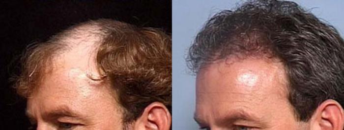 Hair Transplant Case 108 Before & After View #2 | Louisville, KY | CaloSpa® Rejuvenation Center