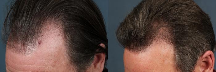 Before & After Hair Transplant Case 261 View #1 View in Louisville, KY