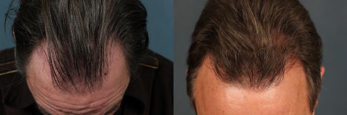 Hair Transplant Case 261 Before & After View #2 | Louisville, KY | CaloSpa® Rejuvenation Center