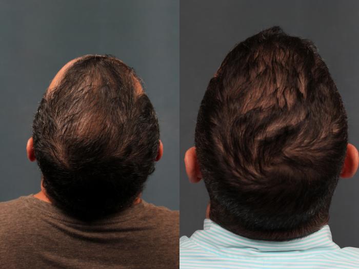 Before & After Hair Transplant Case 262 View #1 View in Louisville, KY