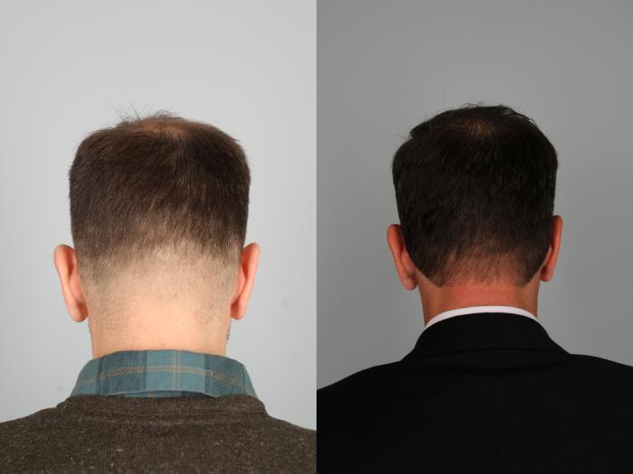 NeoGraft hair restoration treatments offer a minimally invasive hair loss solution for men and women with natural-looking results and fast recovery.
