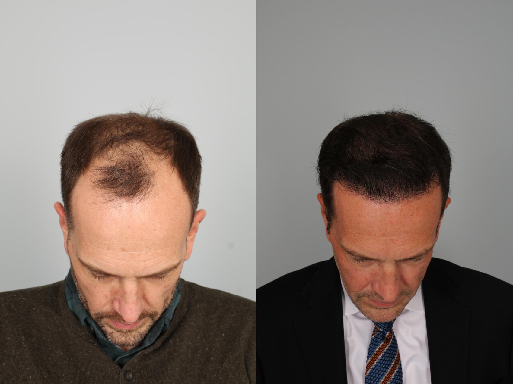 Hair Restoration Recovery