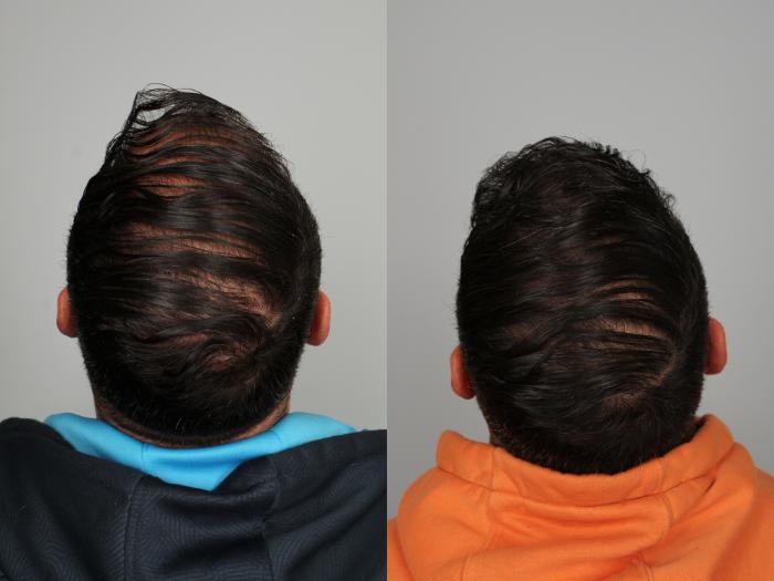 Before & After Hair Transplant Case 764 Back View in Louisville & Lexington, KY