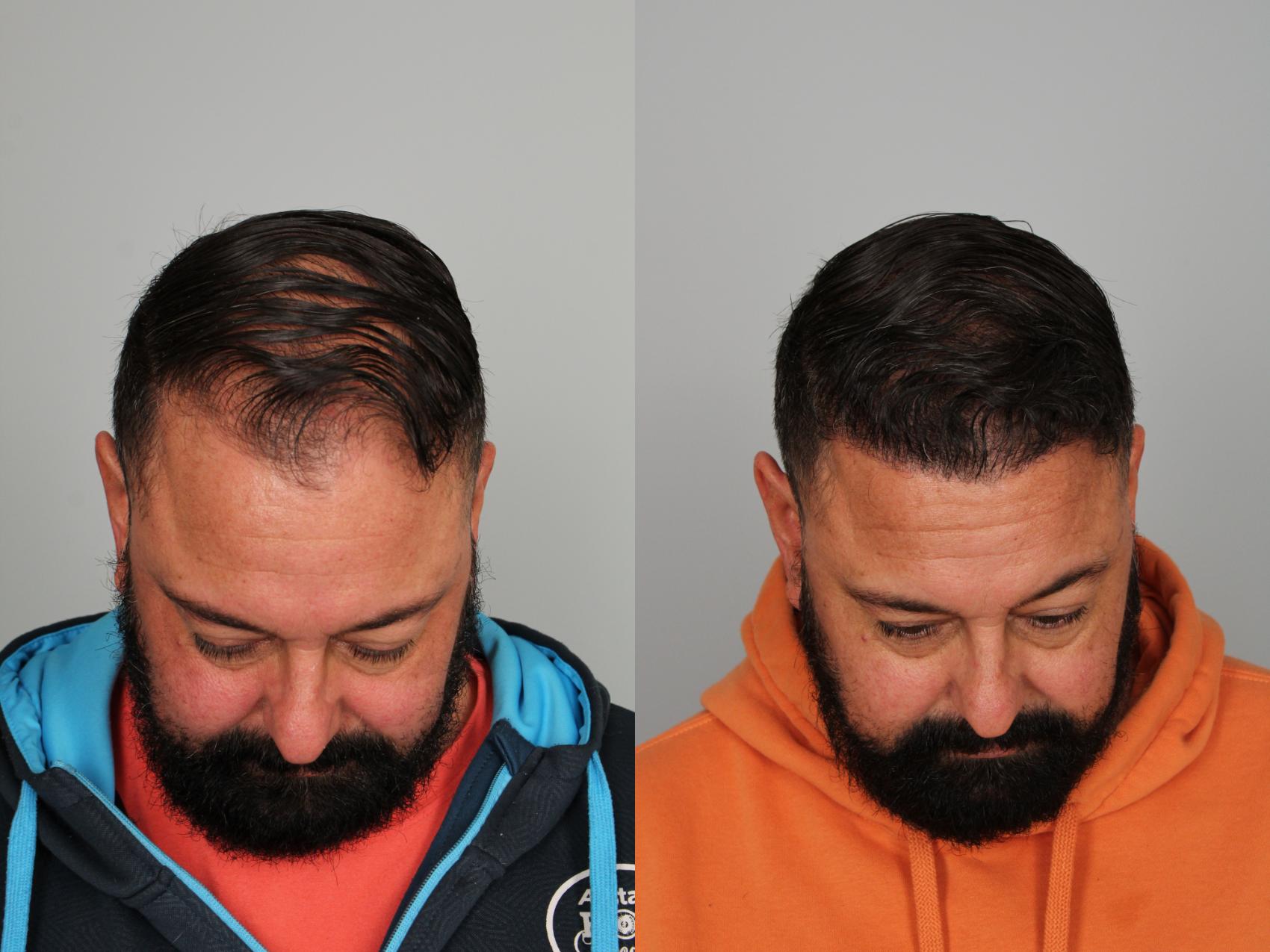 Before & After Hair Transplant Case 764 Front View in Louisville, KY
