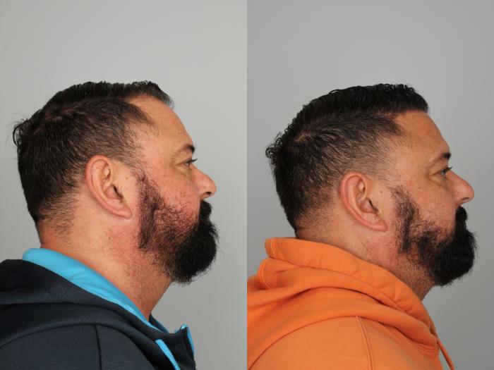 Before & After Hair Transplant Case 764 Right Side View in Louisville & Lexington, KY
