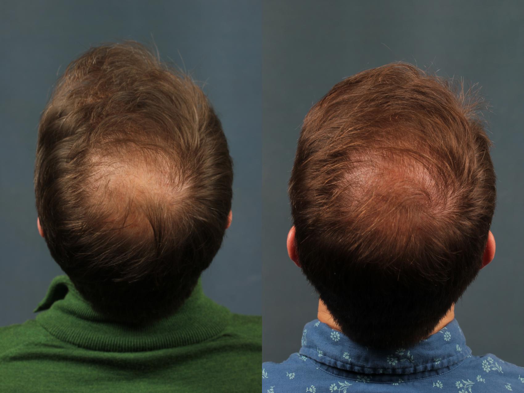 NeoGraft Hair Transplant