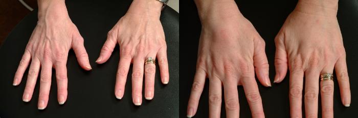 Before & After Hand Rejuvenation Case 631 Back View in Louisville & Lexington, KY