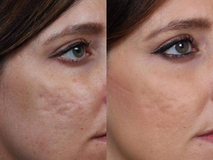 INFINI Case 691 Before & After Right Side | Louisville, KY | CaloSpa® Rejuvenation Center