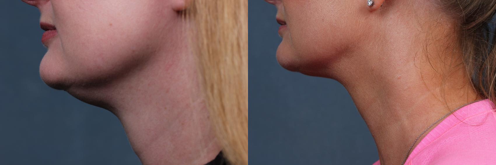 Before & After KYBELLA Case 623 Left Side View in Louisville, KY
