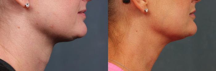 Before & After KYBELLA Case 623 Right Side View in Louisville & Lexington, KY