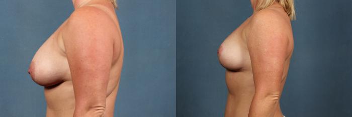 Before & After Lift Case 457 View #3 View in Louisville & Lexington, KY